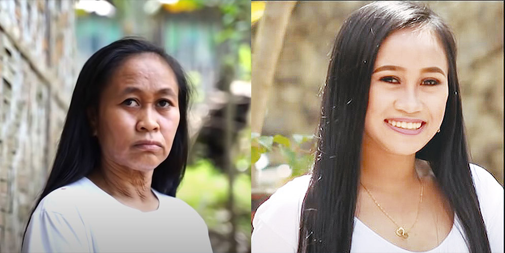 Raizel tiene 16 años, pero por una enfermedad parece de 60 Raizel Calago es una filipina de 16 años, quien hace dos años comenzó a ver una rara transformación en su rostro y en cuerpo, todo por culpa de una extraña enfermedad que la ha perturbado.