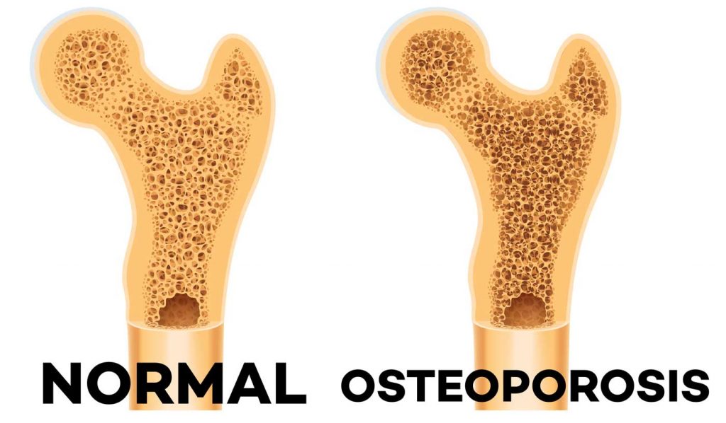 Todo lo que debe saber sobre la osteoporosis Por increíble que parezca, la osteoporosis puede llegar a ser una enfermedad que cause la muerte, pues quien la padece luego de sufrir una fractura a causa de la fragilidad de sus huesos, se enfrenta a un riesgo de fallecimiento entre el 15 y 30%, de acuerdo con estudios.