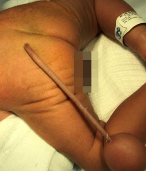 Bebé prematuro nació con una extraña malformación Un raro caso médico se presentó en el hospital infantil Albert Sabin de Fortaleza (Brasil). Resulta que un bebé prematuro (35 meses) nació con una rara malformación en su cuerpo.