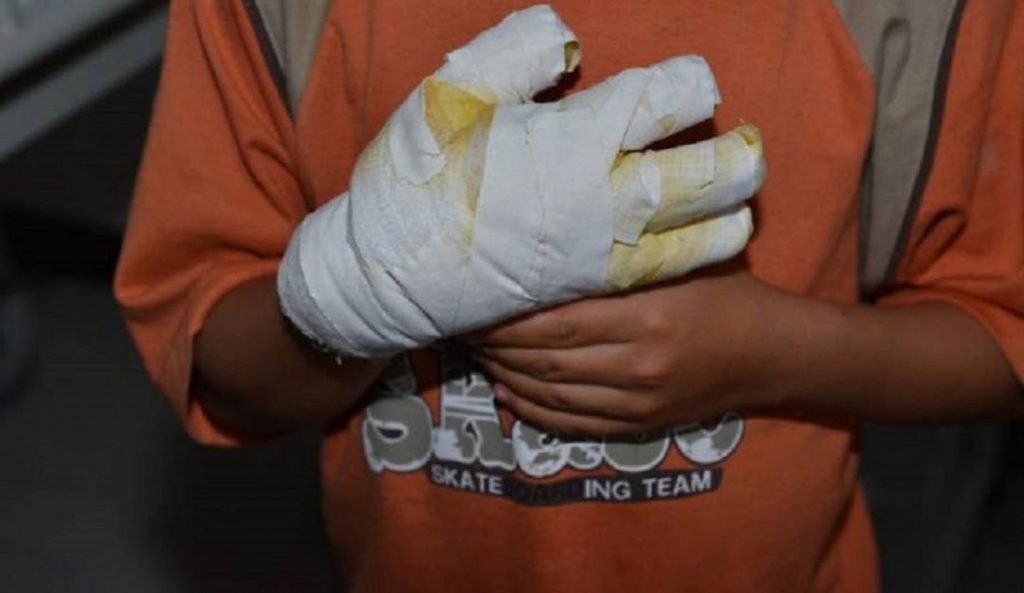 Le quemó las manos a sus hijos por 4 mil pesos En las últimas horas se conoció un grave caso de maltrato contra dos menores en Neiva, Huila. Allí un hombre de 32 años quemó las manos de sus hijos por 4 mil pesos que se le habían extraviado.
