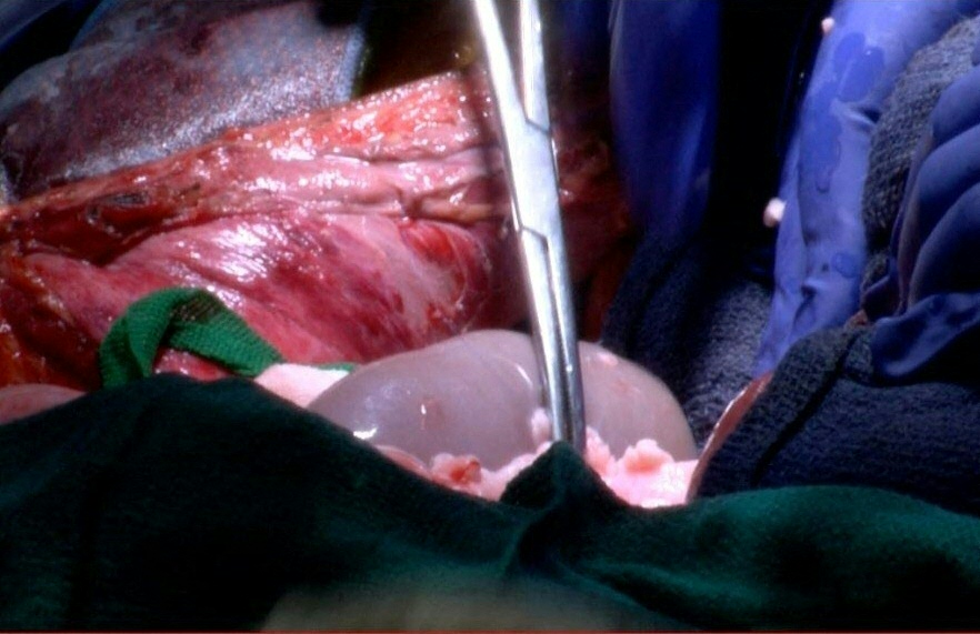 Médicos gringos hicieron trasplante de riñón de cerdo a humano Un equipo médico estadounidense anunció el jueves que había llevado a cabo el segundo trasplante de riñón ya conocido de un cerdo a un ser humano, el primero dentro del cuerpo de un receptor con muerte cerebral.