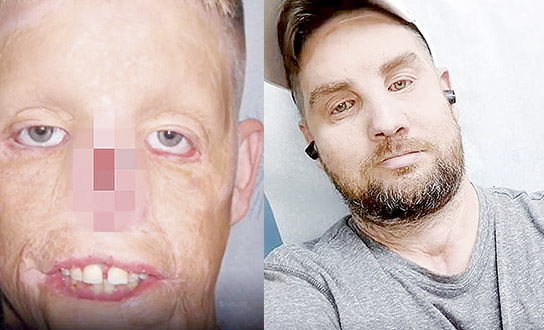 Así fue su cambio luego de un transplante de cara Hace 11 años Mitch Hunter, un exsoldado estadounidense, vivió el peor momento de su vida cuando se estrelló en su auto con una torre eléctrica de 10 mil voltios, sufriendo graves quemaduras y la desfiguración de su rostro.