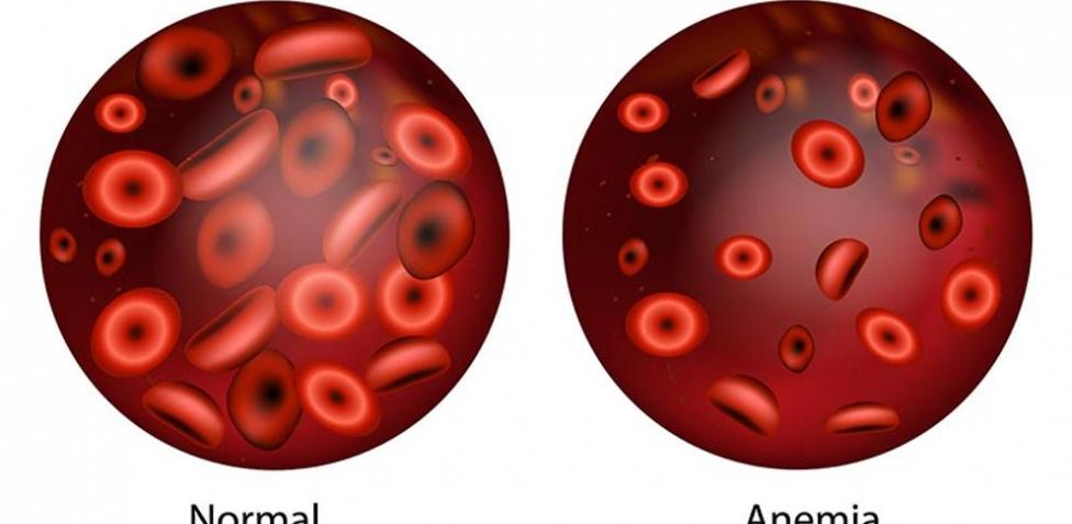 ¡A SUBIR LOS GLÓBULOS ROJOS! La anemia es una afección por la cual el cuerpo no produce suficientes glóbulos rojos sanos, que son los que les suministran el oxígeno a los tejidos corporales. La anemia por deficiencia de hierro es la más común.