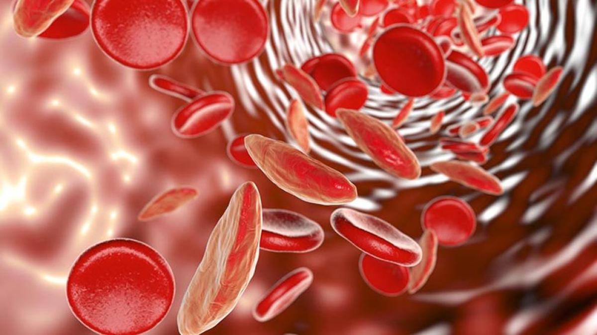 ¡A SUBIR LOS GLÓBULOS ROJOS! La anemia es una afección por la cual el cuerpo no produce suficientes glóbulos rojos sanos, que son los que les suministran el oxígeno a los tejidos corporales. La anemia por deficiencia de hierro es la más común.