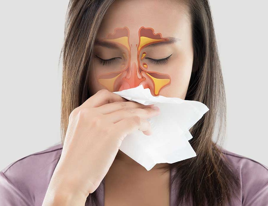 Rinitis alérgica y vírica... La rinitis alérgica es un diagnóstico asociado con un conjunto de síntomas que afectan la nariz. Estos síntomas se presentan cuando usted inhala algo a lo que es alérgico, como polvo, caspa o polen. Los síntomas también pueden ocurrir cuando usted consume alimentos a los que es alérgico.