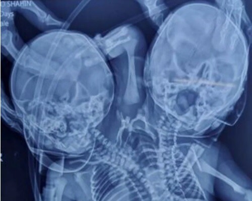 Mujer que esperaba gemelos tuvo un solo bebé con dos cabezas y tres brazos El nacimiento de un bebé causó sorpresa en los médicos y los padres al darse cuenta que tenía una cabeza y un brazo de más. El hecho es conocido científicamente como parapagus dicefálico, una condición en la que dos cráneos separados comparten un mismo torso.