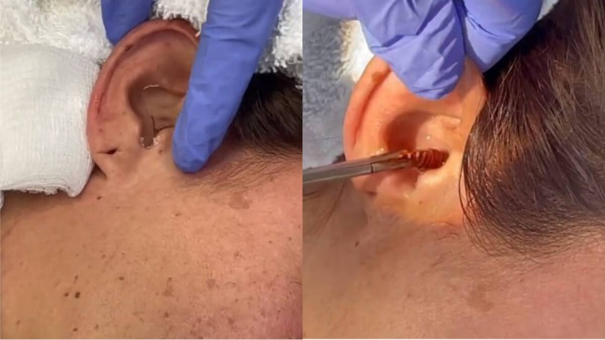 ¡Que horror! A joven se le metió una cucaracha en el oído mientras dormía Posteriormente, los profesionales la revisaron y descubrieron que tenía una cucaracha viva dentro de su cavidad auditiva.