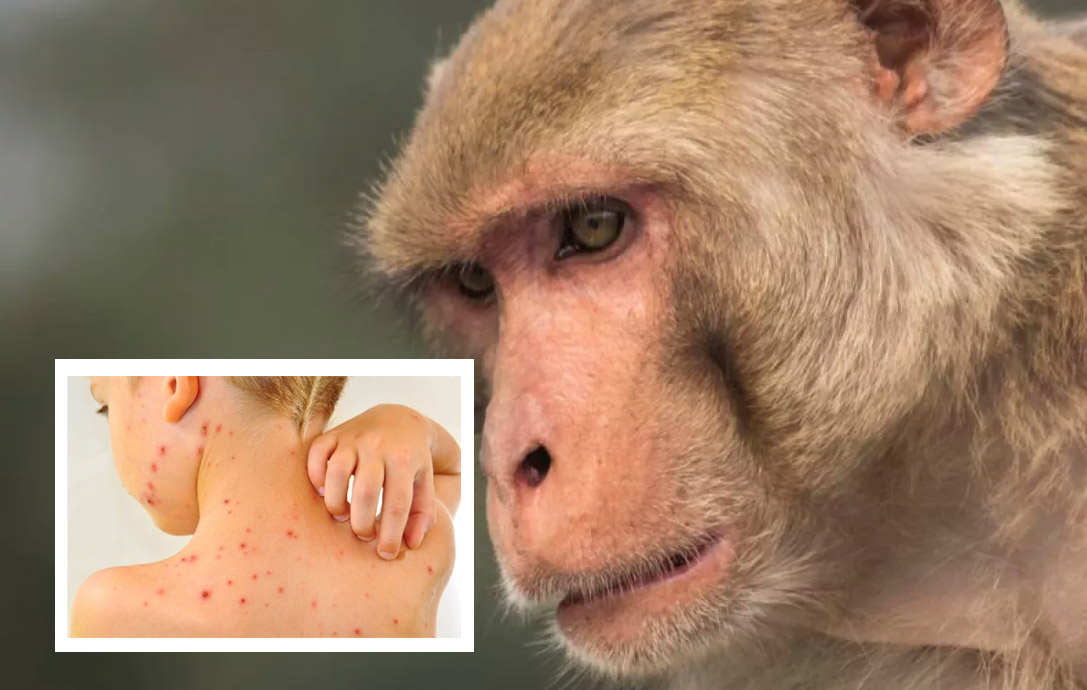 En Colombia no se han confirmado casos de viruela del mono El Instituto Nacional de Salud descartó que por el momento se hayan detectado casos de viruela del mono en Colombia.