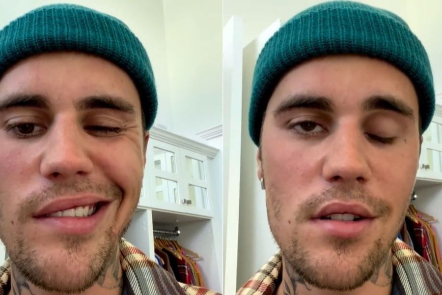 La parálisis facial que afecta a Justin Bieber En las últimas horas, se conoció que el cantante Justin Bieber pospuso algunos conciertos debido a una parálisis facial que presenta.
