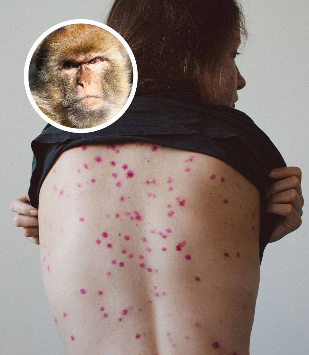 Viruela del mono: Ya hay dos casos confirmados en Bogotá El Instituto Nacional de Salud (INS) confirmó los dos casos de viruela símica (o viruela del mono) en dos hombres entre 28 y 45 años residentes en la ciudad de Bogotá, quienes viajaron a Europa en los últimos días.