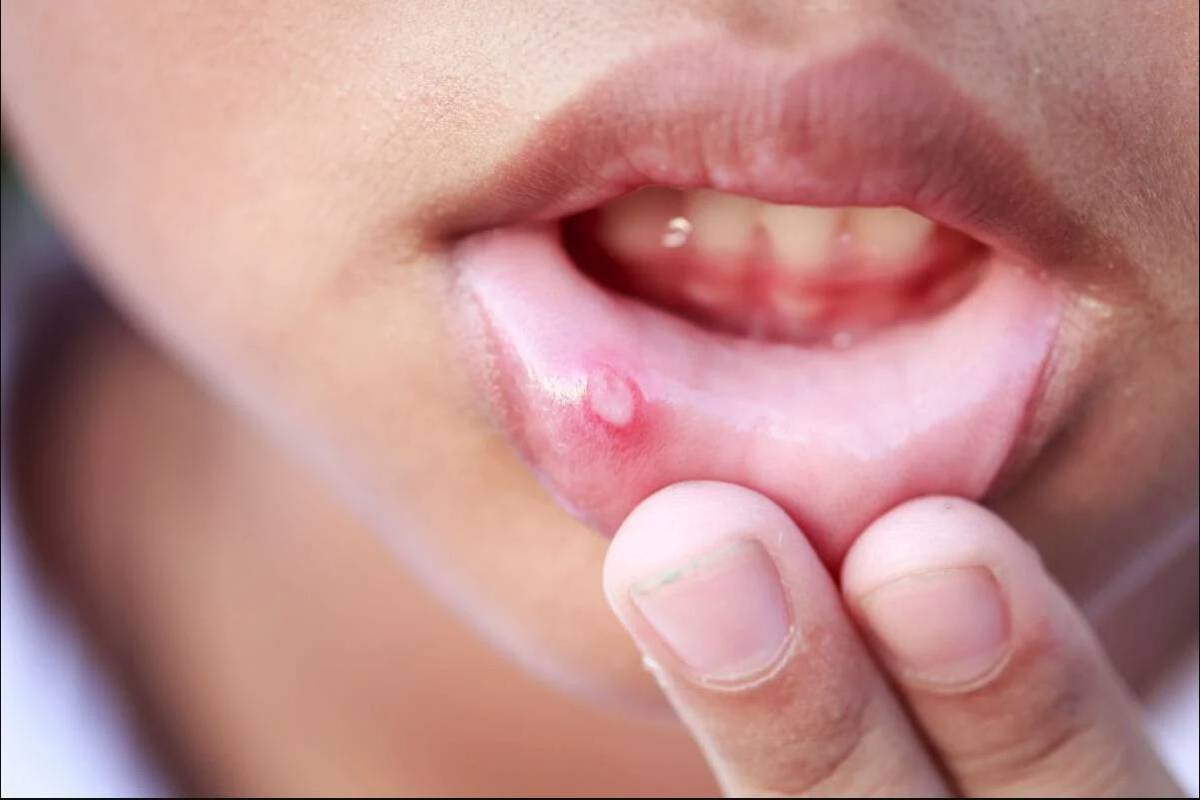 Molestas y dolorosas, úlceras bucales Hay diferentes tipos de úlceras bucales y pueden aparecer en cualquier parte dentro de la boca, incluso el fondo de la boca, la parte interna de las mejillas, las encías, los labios y la lengua.