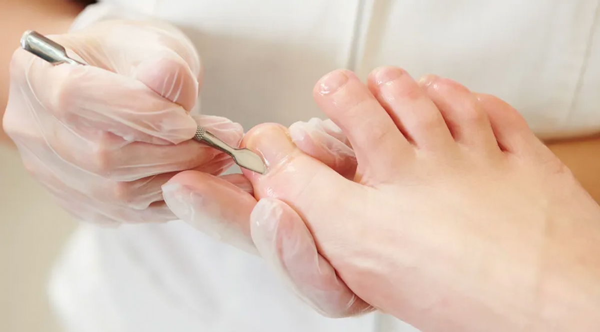 Los dolorosos uñeros Habitualmente se localiza alrededor de las uñas, en su unión con la piel. Se producen pequeñas heridas en el ángulo de la piel que cubre la base de la uña, normalmente por alguna deficiencia a la hora de cortarla.