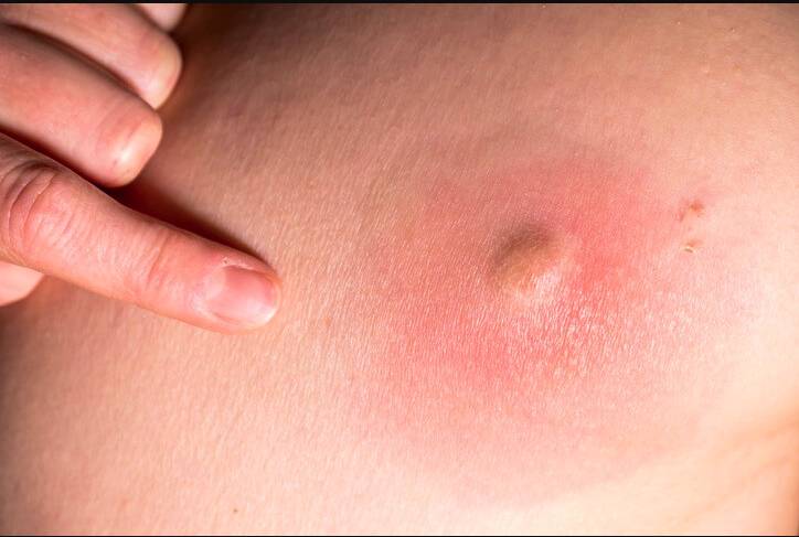 Póngale cuidado a los abscesos de la piel Los abscesos cutáneos son comunes y afectan a personas de todas las edades. Se presentan cuando una infección provoca la acumulación de pus en la piel.
