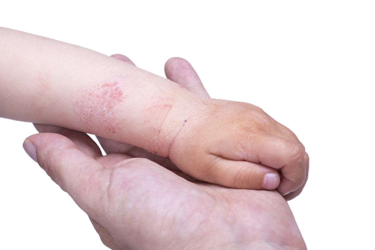 Reportan aumento de casos de dermatitis relacionados al covid-19 La doctora Claudia Marcela Arenas Soto, dermatóloga y vicepresidente de la Asociación Colombiana de Dermatología, afirmó que el virus del Covid-19 también afectó las enfermedades de la piel.
