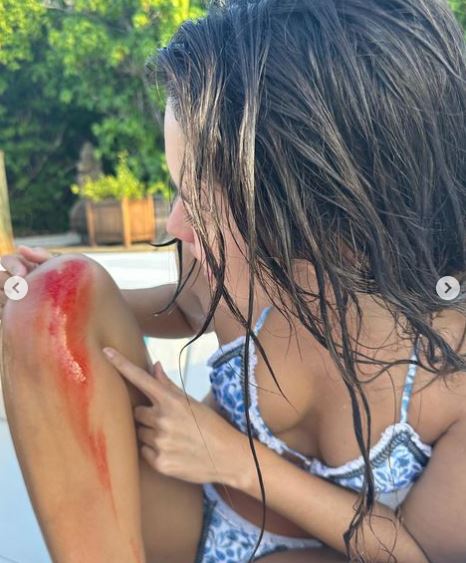 Paulina Vega se accidentó en pleno paseo La hermosa exreina de belleza Paulina Vega compartió en sus redes sociales que tuvo un accidente en medio de sus lujosas vacaciones en un yate.