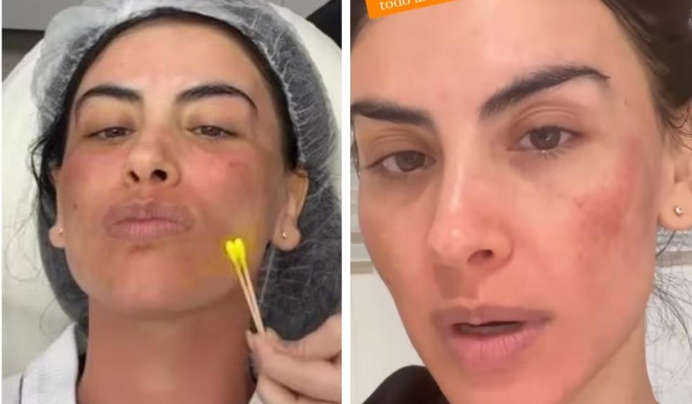 Por un tratamiento, Jessica Cediel tuvo tremendo cambio en su rostro Esta vez, Jessica Cediel compartió la evolución de su rostro luego de un tratamiento. El video sorprendió a los internautas!
