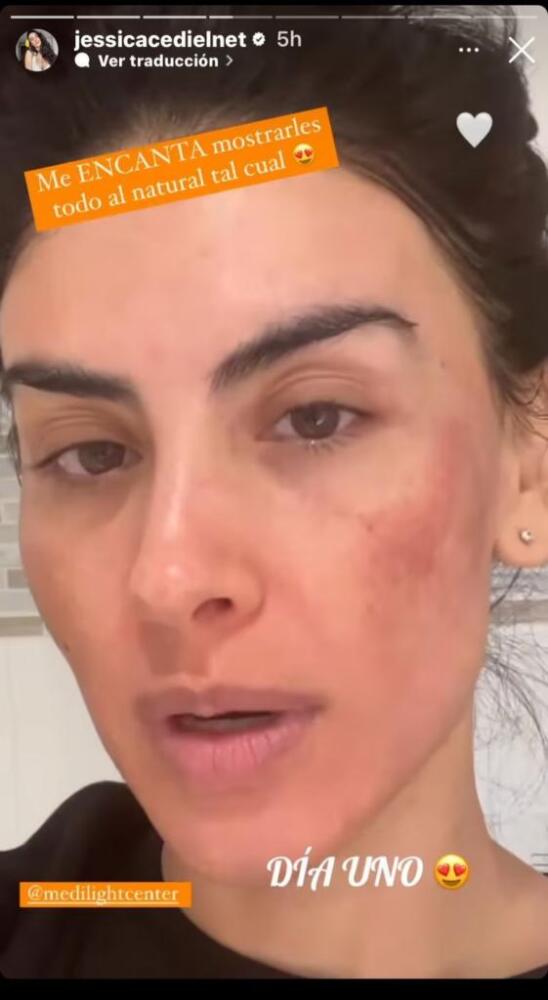 Por un tratamiento, Jessica Cediel tuvo tremendo cambio en su rostro Esta vez, Jessica Cediel compartió la evolución de su rostro luego de un tratamiento. El video sorprendió a los internautas!