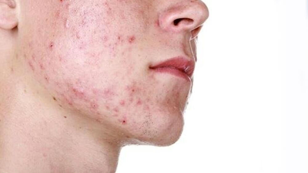 Aprenda a prevenir las cicatrices causadas por el acné Tenga en cuenta algunos consejos para que aprenda a prevenir las cicatrices causadas por el acné.