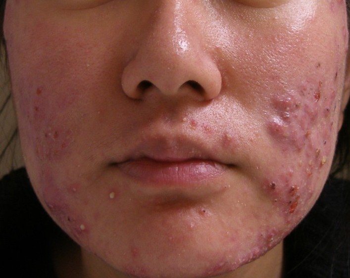 Aprenda a prevenir las cicatrices causadas por el acné Tenga en cuenta algunos consejos para que aprenda a prevenir las cicatrices causadas por el acné.