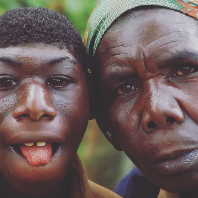 ‘El Niño de la Selva’ que conmueve al mundo Por su aspecto físico, Zanziman Ellie, un joven de Ruanda (África), ha tenido que soportar toda clase de comentarios malintencionados, al punto de ser llamado despectivamente ‘mono’.
