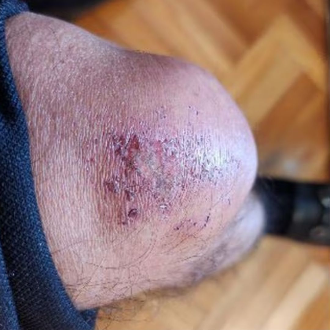 El 'Reto de la rodilla' impulsado por Petro La foto de la rodilla del presidente Gustavo Petro impulsó un nuevo reto en X.