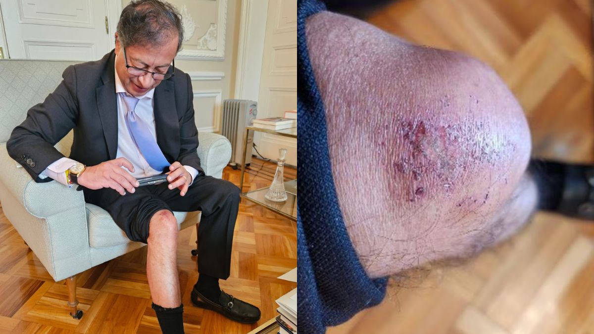El 'Reto de la rodilla' impulsado por Petro La foto de la rodilla del presidente Gustavo Petro impulsó un nuevo reto en X.
