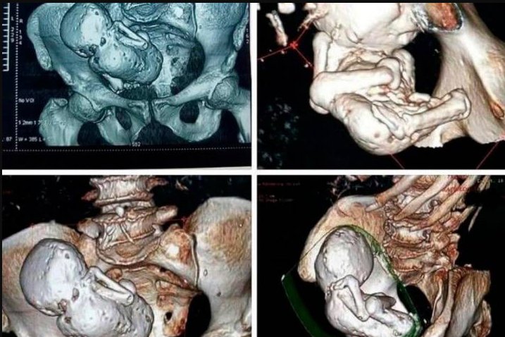 Anciana tenía un ‘bebé de piedra’ en su vientre y lo descubre 35 años después Una tomografía computarizada arrojó un sorprendente hallazgo: un “bebé de piedra” dentro del útero de una mujer de 73 años en Argelia.