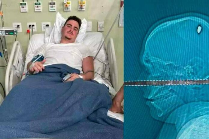 Joven se fue de fiesta por cuatro días sin saber que tenía una bala en la cabeza En Brasil, el joven Mateus Facio estuvo de fiestas y terminó en cuidados intensivos por una bala en su cabeza.
