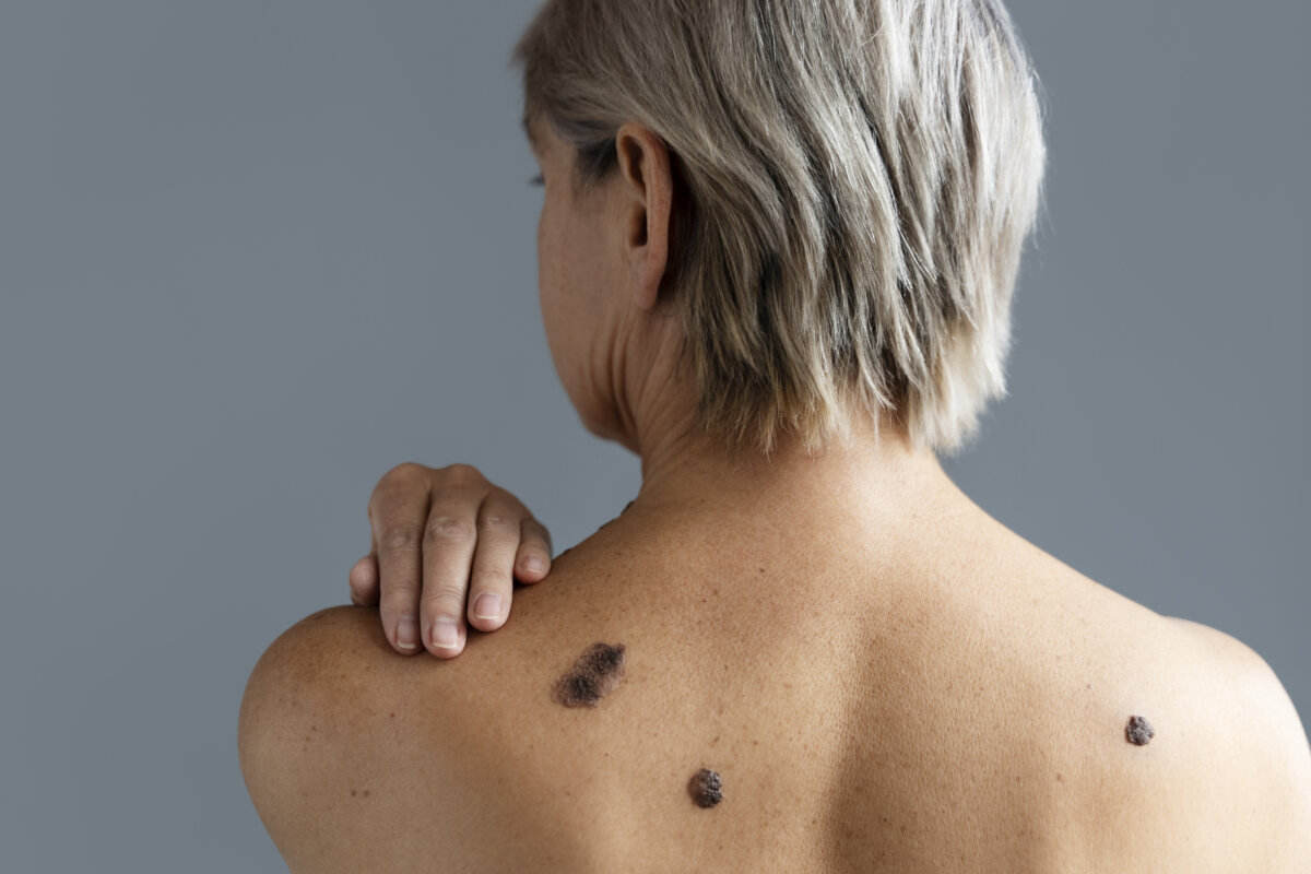 ¡Aprenda a proteger su piel! La incidencia del cáncer de piel, incluido el melanoma, ha experimentado un notable aumento en los últimos años. Según un estudio, se estima que para el año 2040 el melanoma será el segundo tumor más frecuente a nivel mundial.