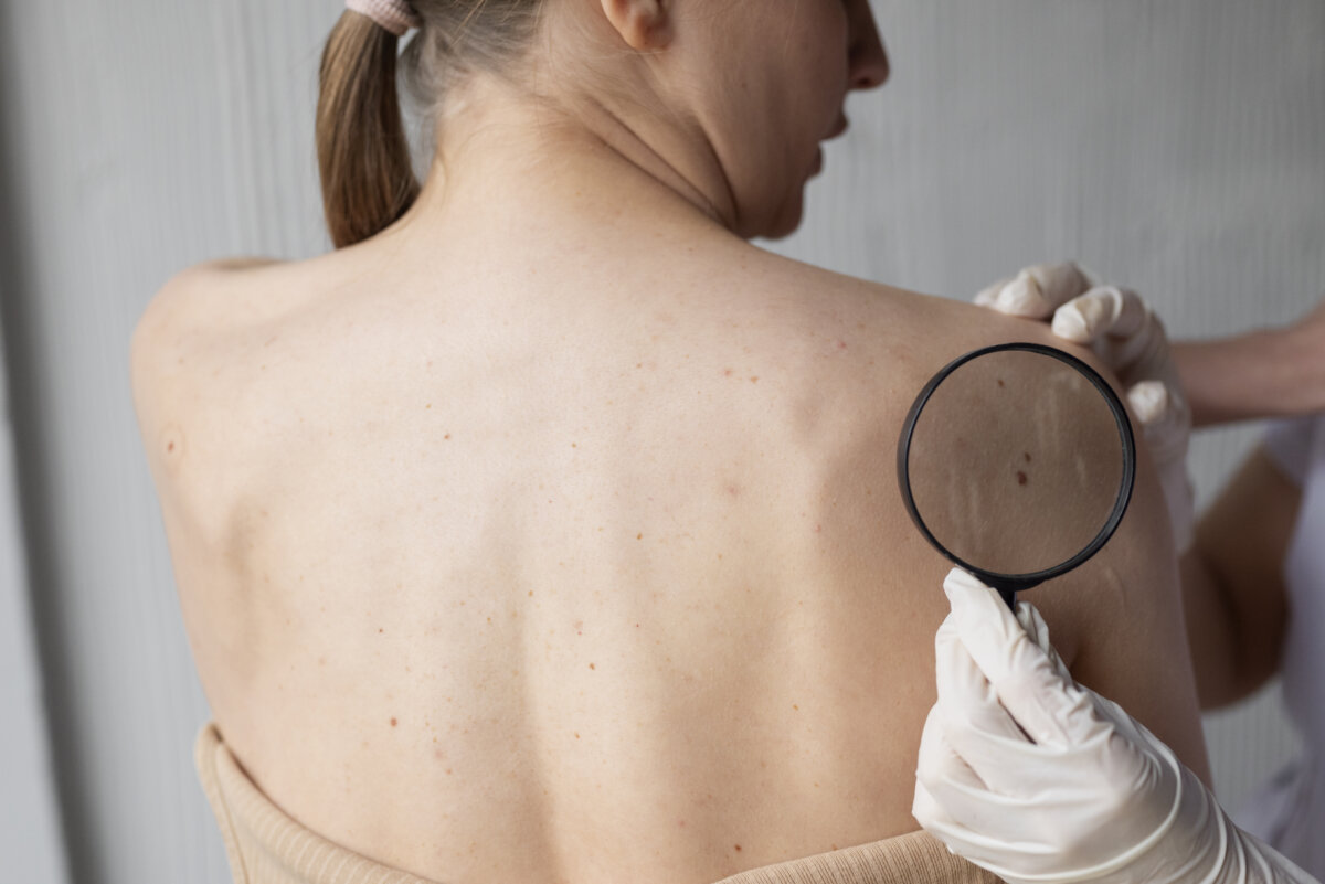 ¡Aprenda a proteger su piel! La incidencia del cáncer de piel, incluido el melanoma, ha experimentado un notable aumento en los últimos años. Según un estudio, se estima que para el año 2040 el melanoma será el segundo tumor más frecuente a nivel mundial.